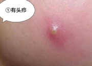 疮疖是什么_皮肤急性化脓炎症的症状与病因解析