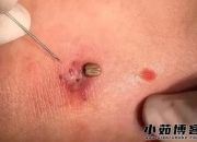 蜱虫叮咬症状图解：皮肤反应与警示信号高清展示