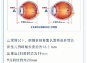 近视成因探析：眼轴变长与用眼习惯的影响